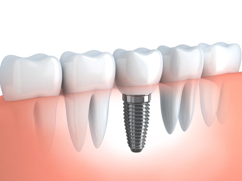 Dental Implants  Springfield, MA 