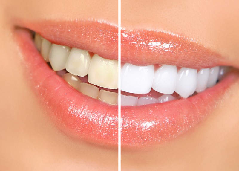 Teeth Whitening  Springfield, MA 